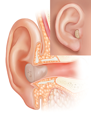 Cross section of ear showing outer ear structures with in-the-canal hearing aid in place and inset of external view.