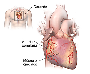 Vista frontal del corazón donde se observan las arterias coronarias y un localizador de corazón sobre el torso de un hombre.