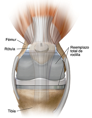 Vista frontal de una articulación de rodilla con un reemplazo total de rodilla.