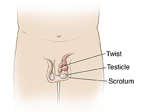 Front view of boy's pelvic area showing testicular torsion.