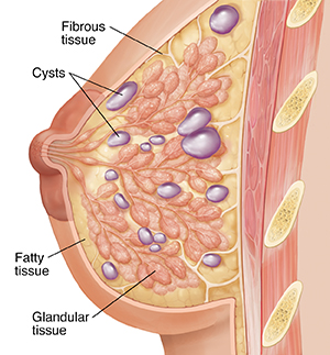 Side view cross section of breast showing glandular, fibrous, and fatty tissue. Multiple cysts throughout breast.