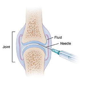 Needle inserted into joint, drawing out fluid.