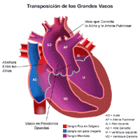 Anatomía de un corazón con transposición de las grandes arterias