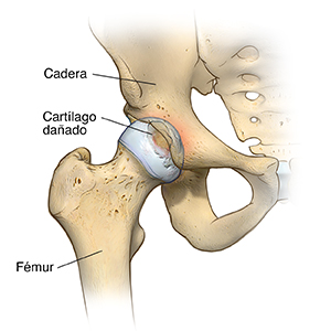 Vista frontal de una articulación de la cadera con artrosis.