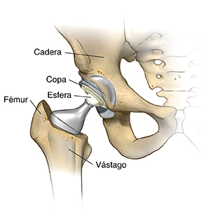 Vista frontal de la articulación de la cadera con reemplazo de cadera colocado.