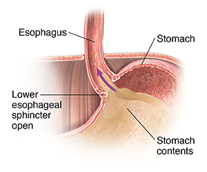 Closeup cross section of top part of stomach, lower esophagus, and diaphragm showing lower esophageal sphincter open, allowing stomach contents to flow into esophagus.