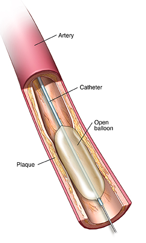 Partial cross section of artery showing balloon catheter inserted next to plaque buildup. Balloon is open and compressing plaque.