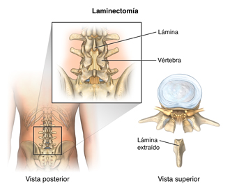 La columna vertebral y una vértebra con la lámina eliminado